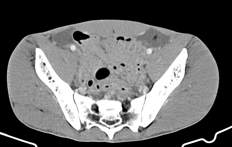 Blunt injury to the small bowel (Radiopaedia 74953-85987 A 157).jpg