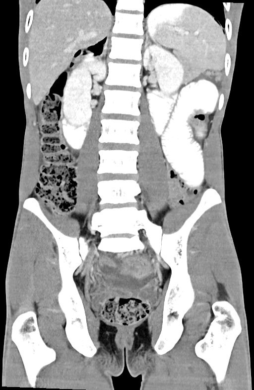 Blunt injury to the small bowel (Radiopaedia 74953-85987 B 63).jpg