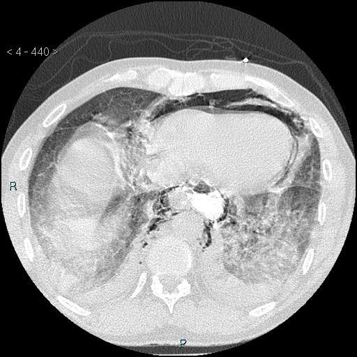 File:Boerhaave syndrome (Radiopaedia 27683-27897 lung window 73).jpg