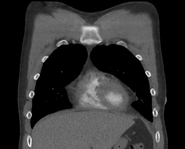 File:Boerhaave syndrome (Radiopaedia 39382-41660 C 23).png
