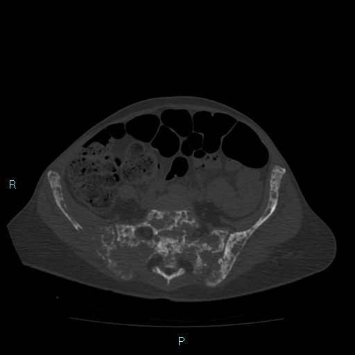 Bone metastases from untreated breast cancer (Radiopaedia 42973-46219 Axial bone window 149).jpg