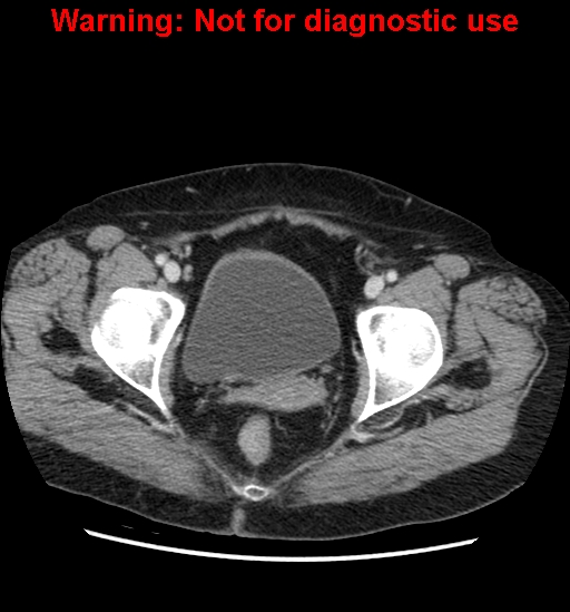 File:Bosniak renal cyst - type II (Radiopaedia 23404-23468 D 68).jpg