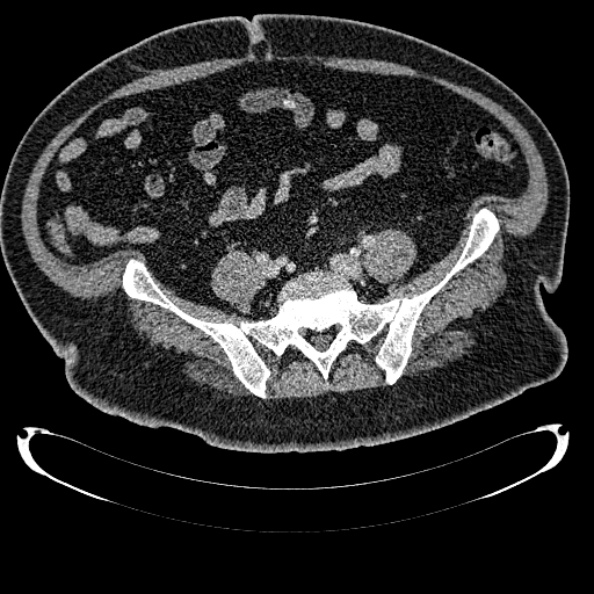 Bosniak renal cyst - type IV (Radiopaedia 24244-24518 C 285).jpg