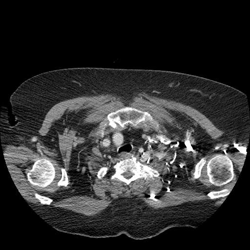 Bovine aortic arch - right internal mammary vein drains into the superior vena cava (Radiopaedia 63296-71875 A 12).jpg