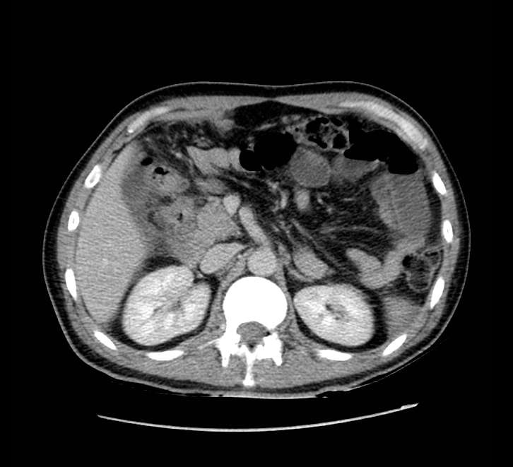Bowel obstruction from colon carcinoma (Radiopaedia 22995-23028 A 27).jpg