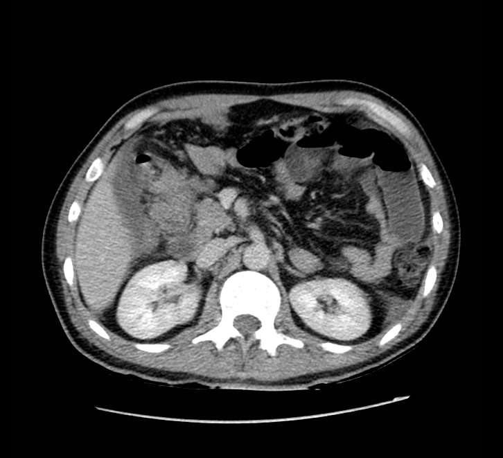 Bowel obstruction from colon carcinoma (Radiopaedia 22995-23028 A 28).jpg