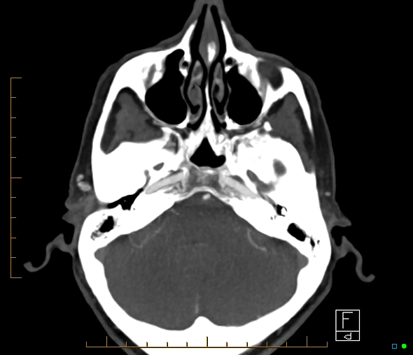 File:Brachiocephalic trunk stenosis (Radiopaedia 87242-103519 A 53).jpg