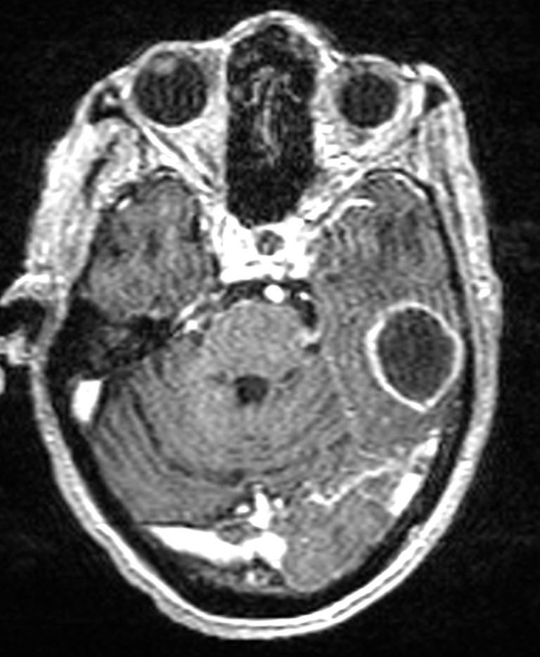 Brain abscess with dual rim sign (Radiopaedia 87566-103938 Axial T1 C+ 55).jpg