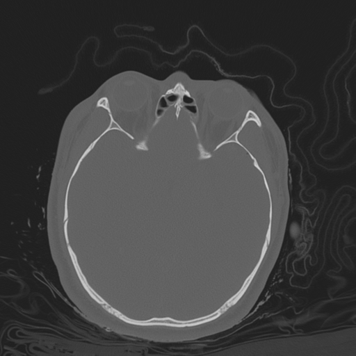 Brain contusions, internal carotid artery dissection and base of skull fracture (Radiopaedia 34089-35339 Axial bone window 69).png