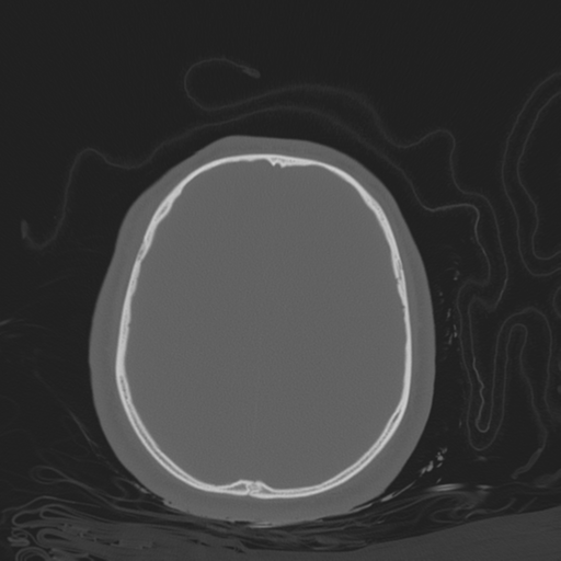 File:Brain contusions, internal carotid artery dissection and base of skull fracture (Radiopaedia 34089-35339 Axial bone window 93).png