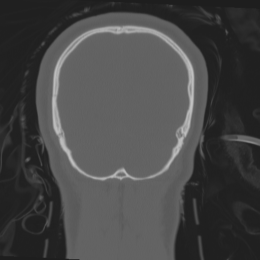 Brain contusions, internal carotid artery dissection and base of skull fracture (Radiopaedia 34089-35339 Coronal bone window 59).png