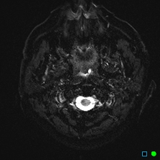 File:Brain death on MRI and CT angiography (Radiopaedia 42560-45689 Axial ADC 2).jpg