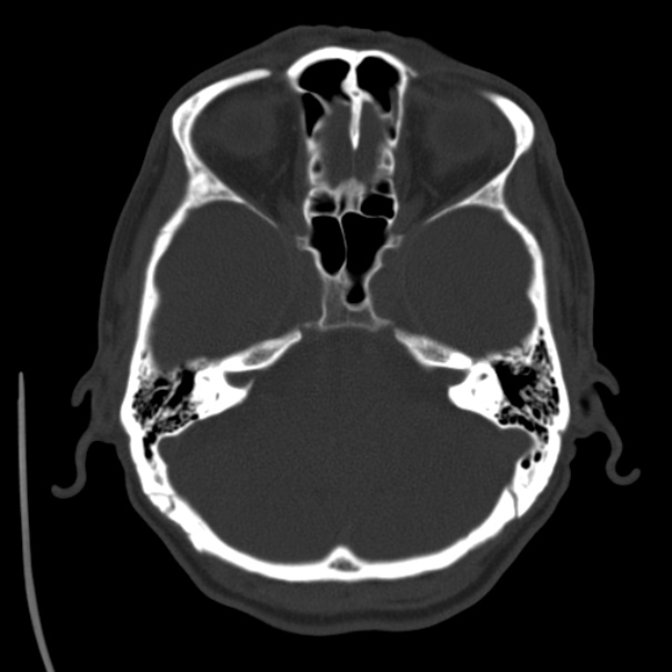 Brain metastases from lung cancer (Radiopaedia 24480-24781 Axial bone window 11).jpg