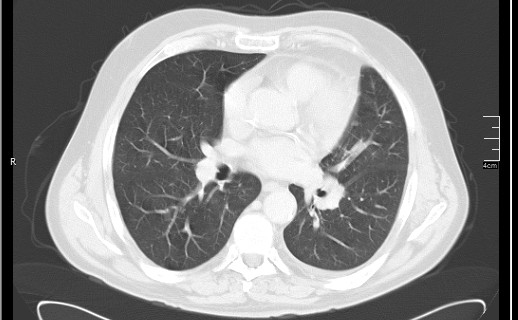 Brain metastases from squamocellular lung cancer (Radiopaedia 56515-63219 Axial lung window 36).jpg