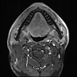 File:Branchial cleft cyst (Radiopaedia 31167-31876 Axial T1 C+ fat sat 17).jpg