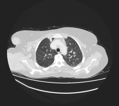 Breast metastases from facial malignant melanoma (Radiopaedia 60316-67975 Axial lung window 22).jpg