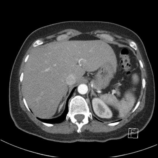 Breast metastases from renal cell cancer (Radiopaedia 79220-92225 A 84).jpg