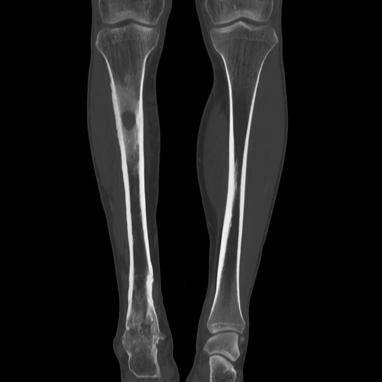 Brodie abscess - tibia (Radiopaedia 66028-75204 Coronal bone window 25).jpg