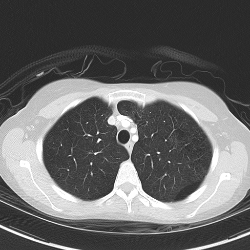 Bronchial atresia (Radiopaedia 73677-84470 Axial lung window 17).jpg