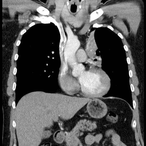 Bronchial carcinoid tumor (Radiopaedia 67377-76764 C 31).jpg