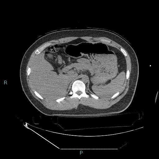File:Bronchial carcinoid tumor (Radiopaedia 78272-90870 Axial non-contrast 109).jpg
