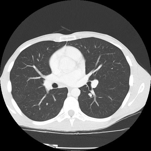 Bronchial carcinoid tumor causing right lower lobe collapse (Radiopaedia 83495-98594 Axial lung window 26).jpg