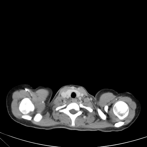 Bronchial mucoepidermoid carcinoma (Radiopaedia 57023-63895 Axial 6).jpg