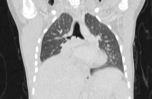 Bronchial mucoepidermoid carcinoma (Radiopaedia 57023-63895 Coronal lung window 16).jpg