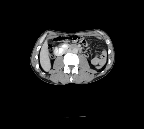 File:Bronchiectasis in Crohn disease (Radiopaedia 60311-67977 B 83).jpg
