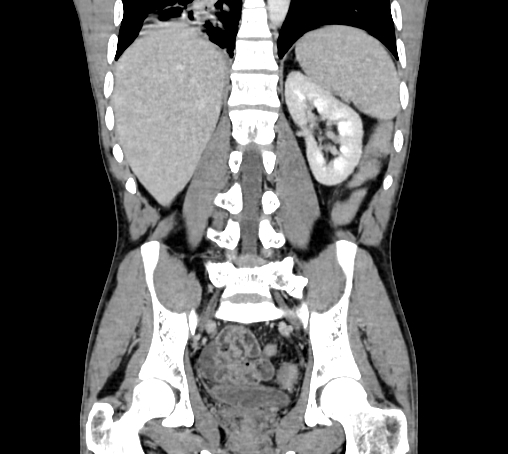 Bronchiectasis in Crohn disease (Radiopaedia 60311-67977 C 56).jpg