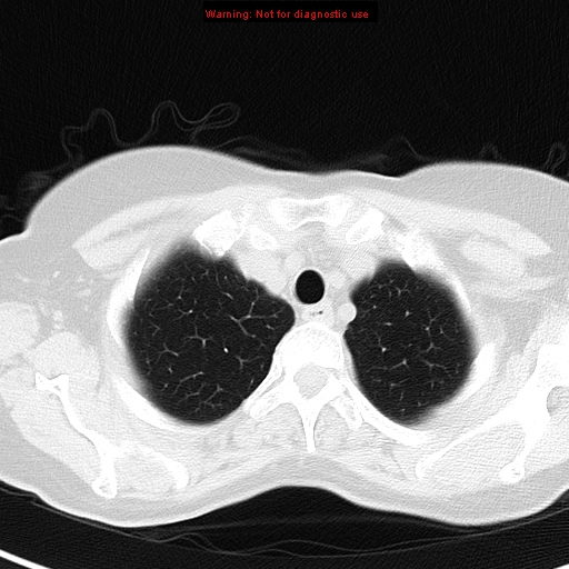 File:Bronchoalveolar carcinoma (BAC) (Radiopaedia 13436-13392 Axial lung window 7).jpg
