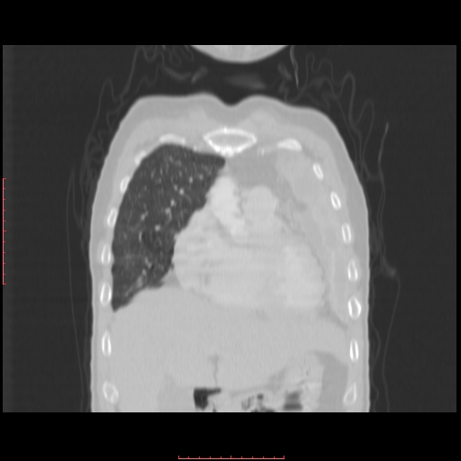 File:Bronchogenic carcinoma with left atrial large deposit - T4N3M1a (Radiopaedia 42316-45428 Coronal lung window 4).jpg