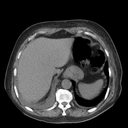 Bronchogenic carcinoma with metastatic lymphadenopathy (Radiopaedia 37671-39569 Axial non-contrast 48).jpg