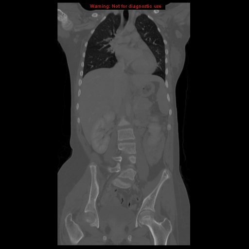 File:Brown tumor (Radiopaedia 12318-12596 D 36).jpg