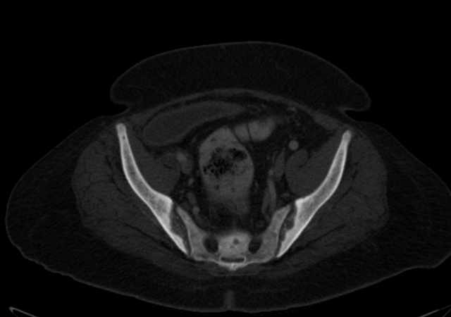 Brown tumors compressing the spinal cord (Radiopaedia 68442-77988 G 102).jpg