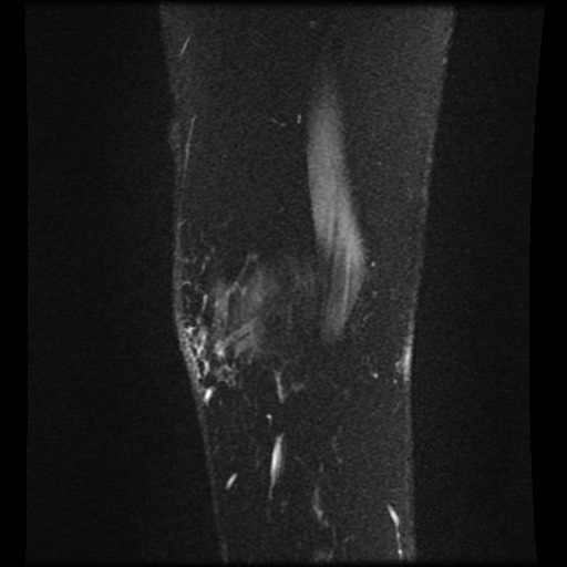 Bucket handle meniscus tear (Radiopaedia 56916-63751 H 83).jpg