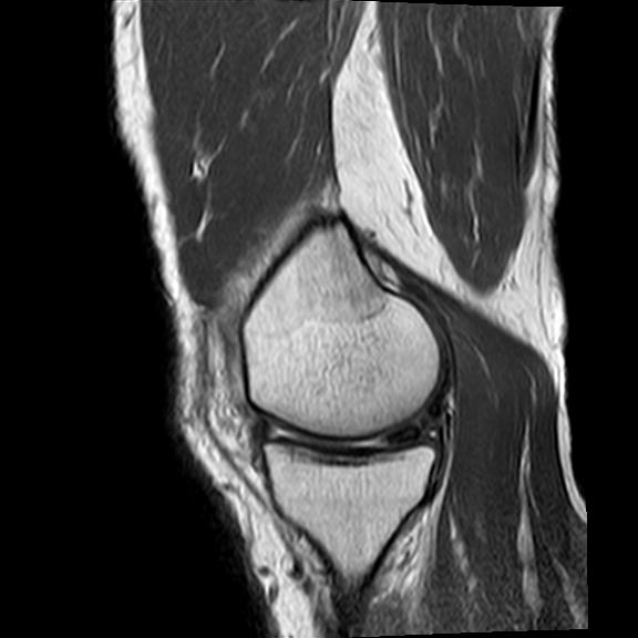 File:Bucket handle tear - medial meniscus (Radiopaedia 29250-29664 Sagittal PD 16).jpg