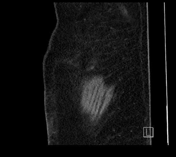 Buried bumper syndrome - gastrostomy tube (Radiopaedia 63843-72577 Sagittal Inject 1).jpg