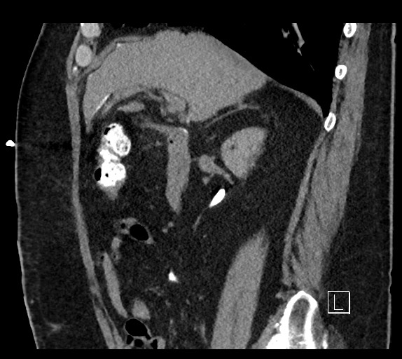 Buried bumper syndrome - gastrostomy tube (Radiopaedia 63843-72577 Sagittal Inject 79).jpg
