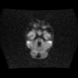 File:Burkitt lymphoma of the orbit- pre and post chemotherapy (Radiopaedia 31214-31930 Axial DWI 5).jpg