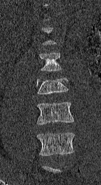 Burst fracture (Radiopaedia 53373-59357 Coronal bone window 13).jpg