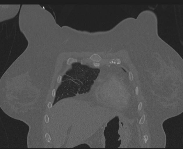 Burst fracture - thoracic spine (Radiopaedia 30238-30865 Coronal bone window 34).jpg