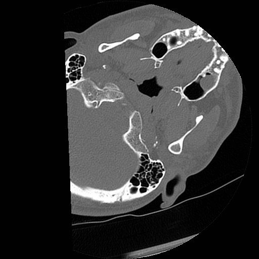 C1-C2 "subluxation" - normal cervical anatomy at maximum head rotation (Radiopaedia 42483-45607 Axial non-contrast 66).jpg