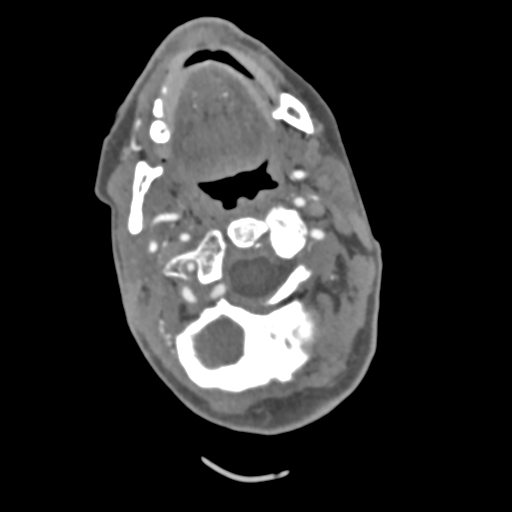 File:C2 fracture with vertebral artery dissection (Radiopaedia 37378-39200 A 173).png