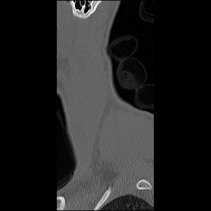C5 facet fracture (Radiopaedia 58374-65499 Sagittal bone window 67).jpg