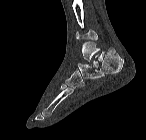 Calcaneal fracture - Sanders type 4 (Radiopaedia 90179-107370 Sagittal bone window 61).jpg