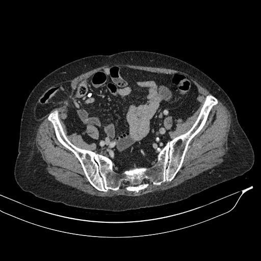 Calcified adrenal glands and Spigelian hernia (Radiopaedia 49741-54988 A 182).jpg