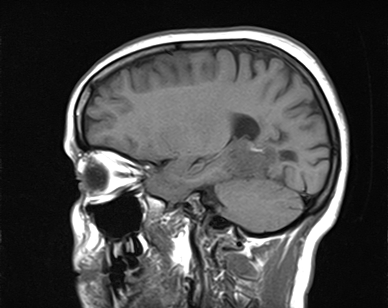 File:Calcified cerebral hydatid cyst (Radiopaedia 65603-74699 Sagittal T1 7).jpg