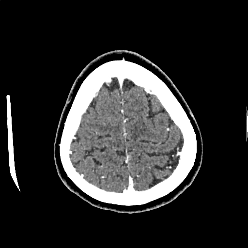 Calcified cerebral hydatid cyst (Radiopaedia 65603-74717 Axial with contrast 71).jpg