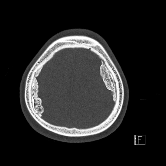 Calcified chronic subdural hematoma (Radiopaedia 77374-89492 Axial bone window 117).jpg